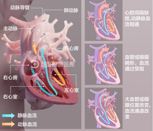 先心病.png
