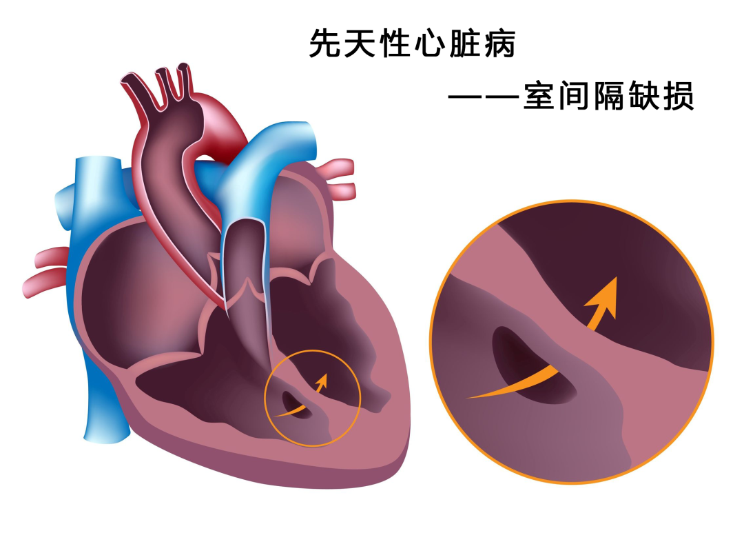 室间隔缺损是最常见的先天性心脏病，外科手术或内科介入可修补、封堵缺损，及时治疗一般预后良好.png